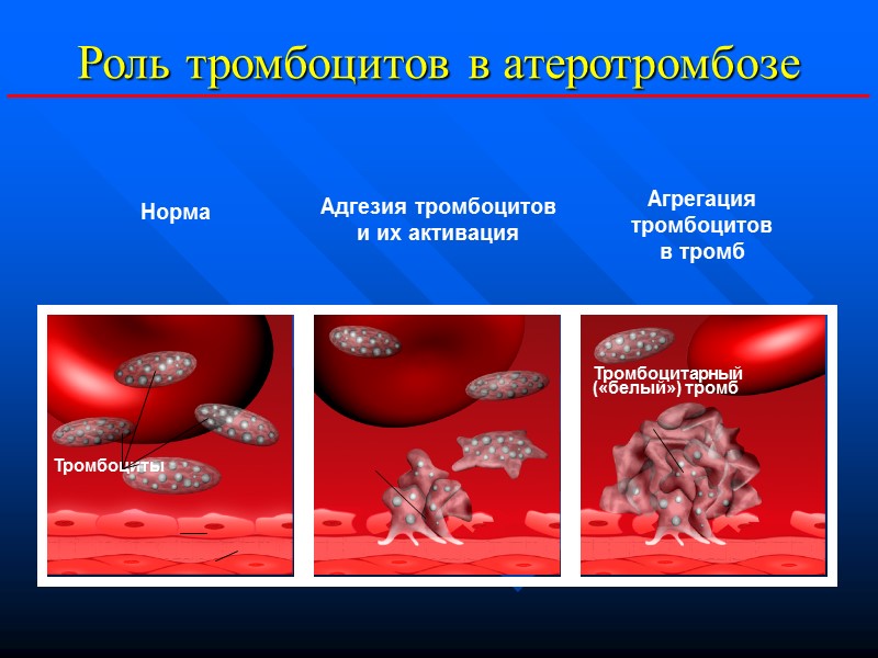 Агрегация тромбоцитов в тромб Тромбоциты Тромбоцитарный («белый») тромб Роль тромбоцитов в атеротромбозе Норма Агрегация тромбоцитов в тромб Тромбоциты Тромбоцитарный («белый») тромб Роль тромбоцитов в атеротромбозе Норма